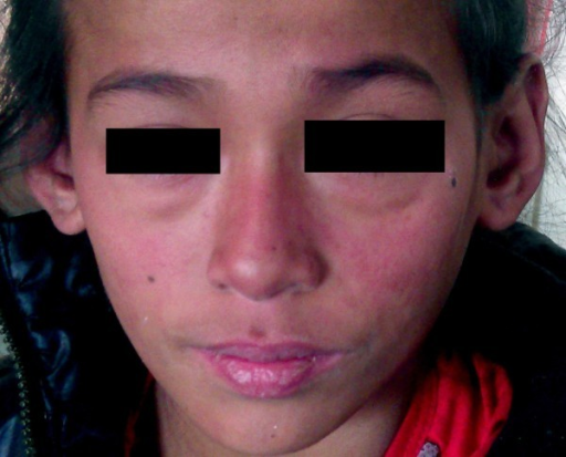 lupus eritematoso discoide